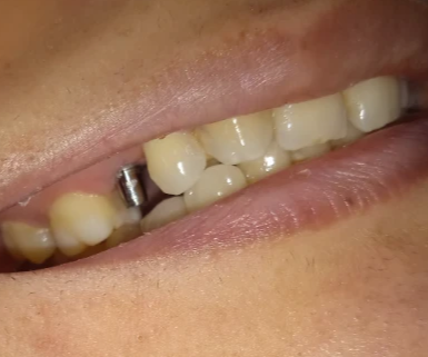 Smile restoration before treatment