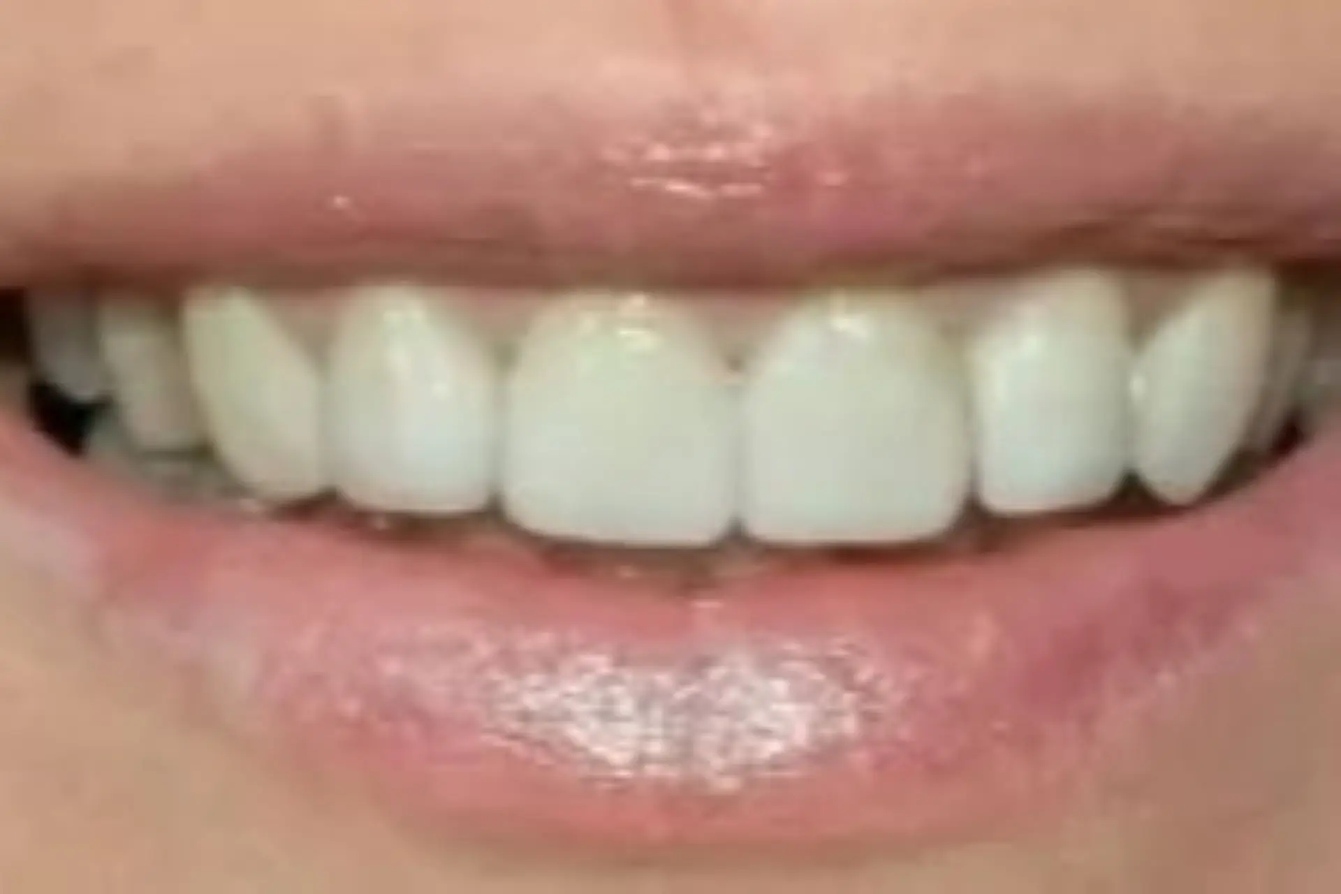 Dental rehabilitation after treatment